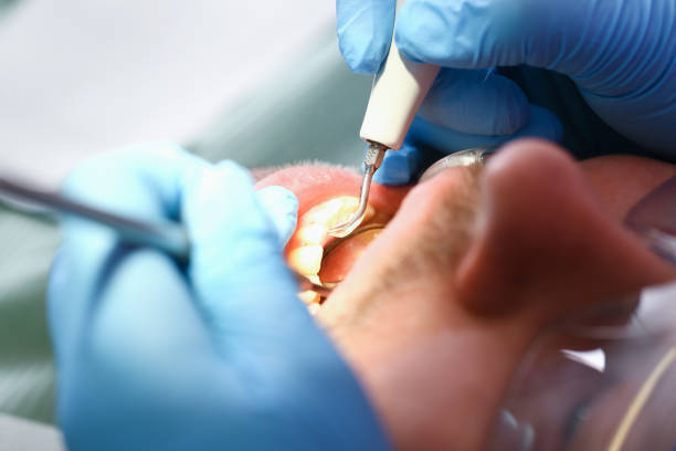 Best Broken or Cracked Tooth Emergency Dentist in Plainedge, NY